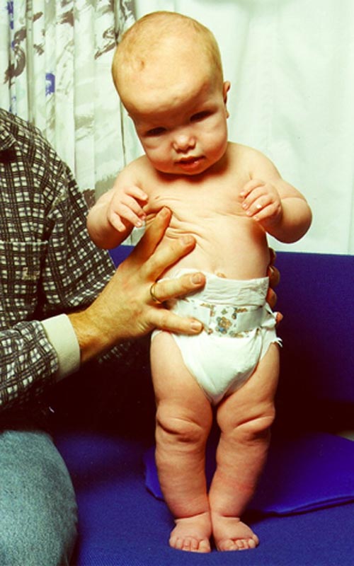 Soto_Syndrome (2).jpg